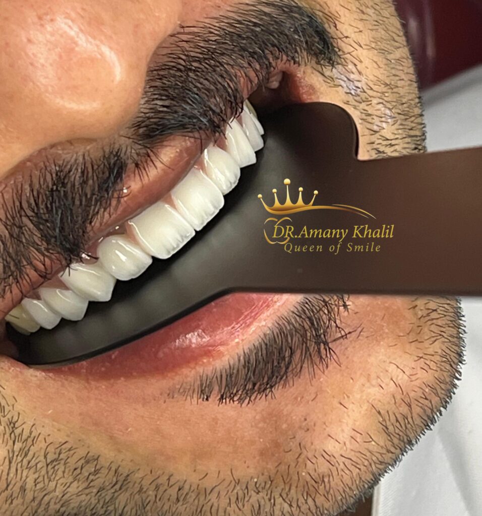 ابتسامة هوليود - تركيبات اسنات - زراعة اسنان - تقويم الاسنان