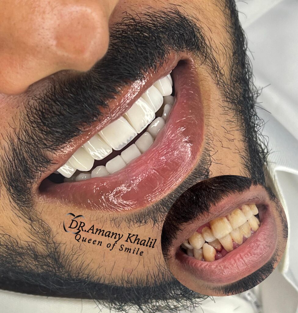 ابتسامة هوليود - تركيبات اسنات - زراعة اسنان - تقويم الاسنان